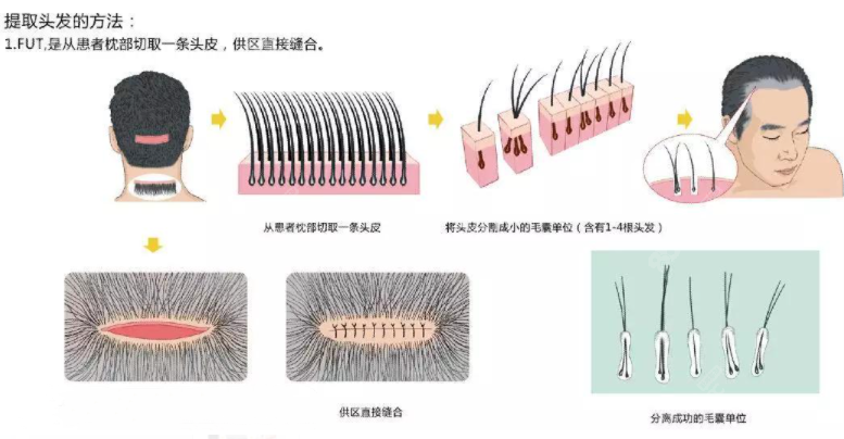 目前植发技术分为2种:fut和fue技术