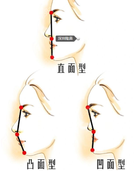 隆鼻中的角度