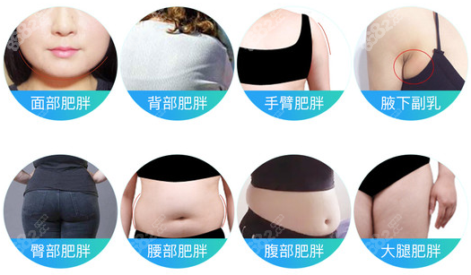 北京新星靓李伟民吸脂手术适应症