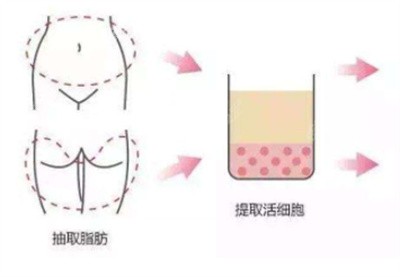 李智勇医生吸脂的参考价格.jpg