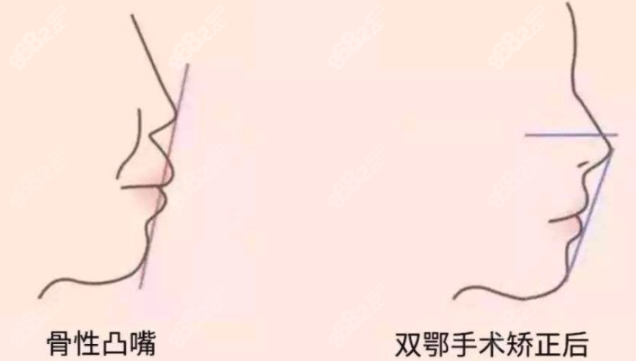 上海时光何晋龙做正颌手术怎么样呢？