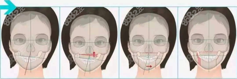 正颌手术对比展示图