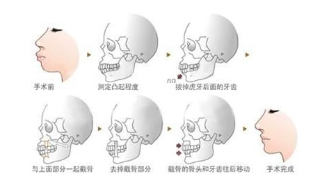正颌手术操作流程展示图