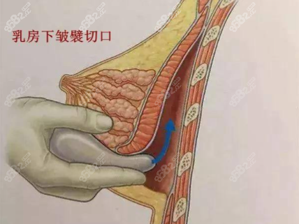 乳房下褶皱切口