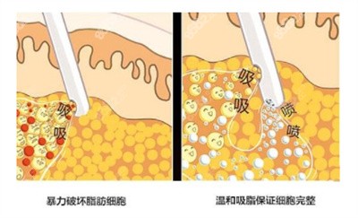 黄志勇医生吸脂的技术优势1.jpg