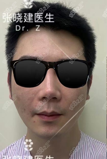 张晓建医师拉皮手术范例