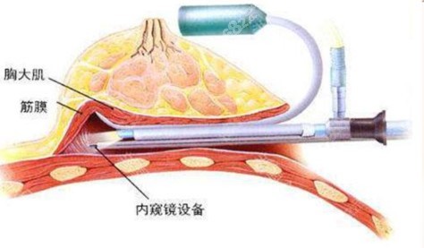 <!--<i data=20240705-sp></i>-->内窥镜隆胸技术