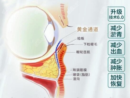 广州健丽专有不开刀祛眼袋技术