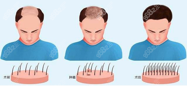 苏州植发哪家医院好呢？