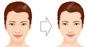 拉皮手术示意图