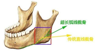 何才伟医生磨骨的技术优势3.jpg