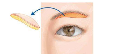 提眉手术示意图
