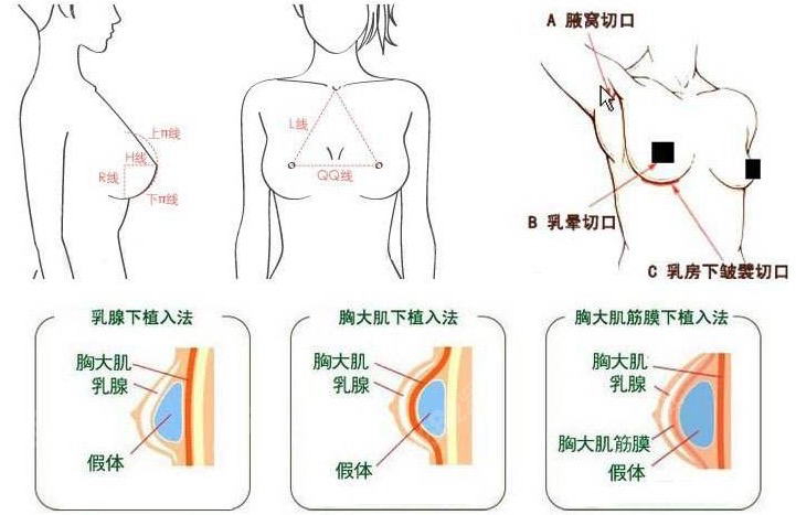 苏州假体隆胸哪家医院做得好呢？