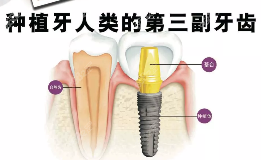 种植牙的组成