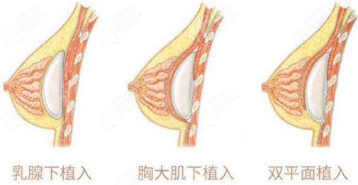 特贝茨双平面隆胸