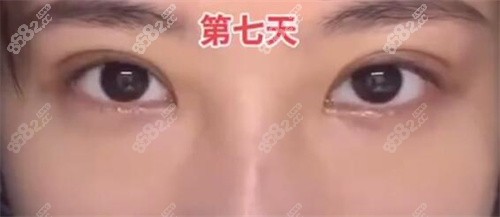 许炎龙肉条眼修复一周后