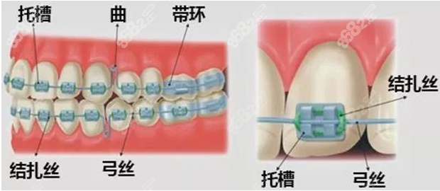 树脂牙贴片卸除后可以戴钢丝牙套吗