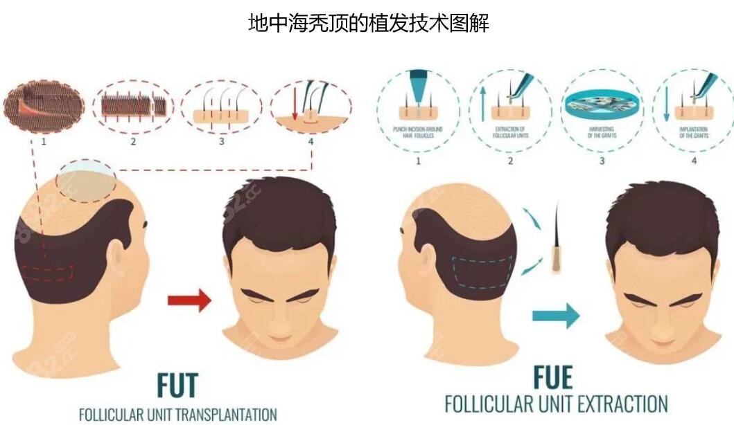 fut和fue植发技术区别