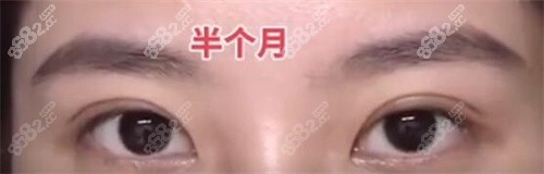 许炎龙肉条眼修复半个月后