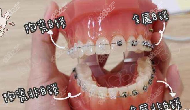 陶瓷自锁和金属自锁的区别