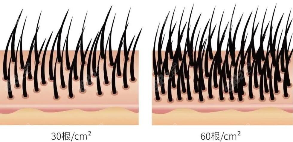 一平方里面种植30根和60根头发的密度