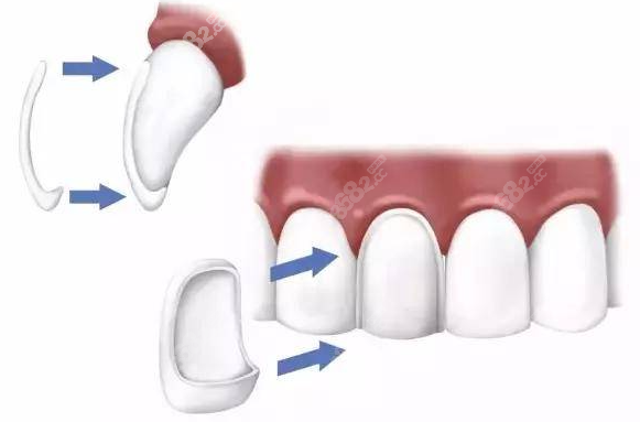 树脂牙贴片卸除后怎么修复原牙