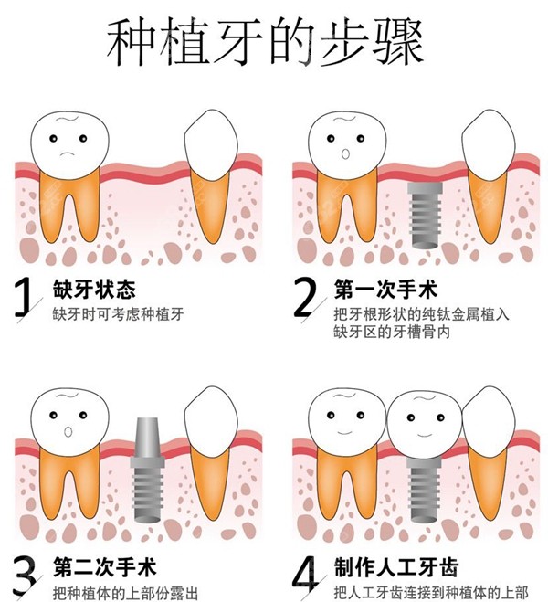 海口口腔医院种植牙过程