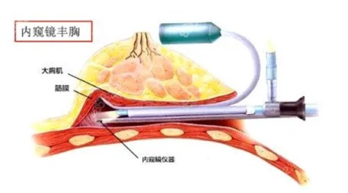 内窥镜丰胸