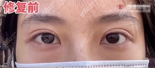 许炎龙肉条眼修复前