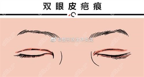 双眼皮疤痕修复