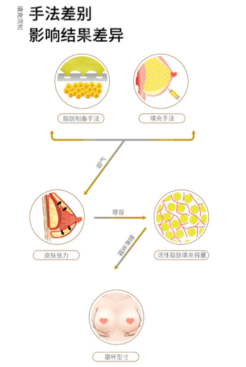 青岛诺德张冠勋医生做自体脂肪隆胸的全过程