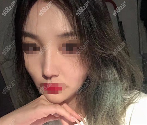 隆鼻术后