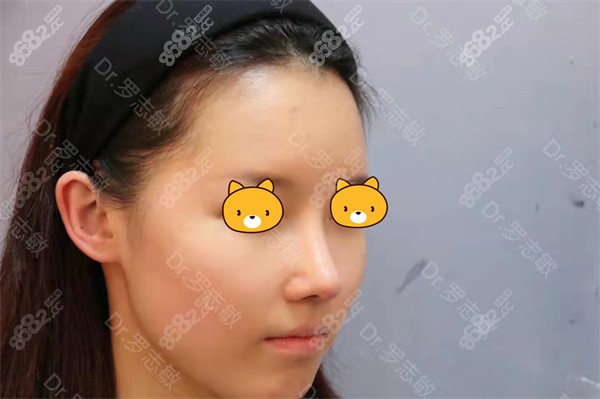 <!--<i data=20240705-sp></i>-->罗志敏做鼻子实例2