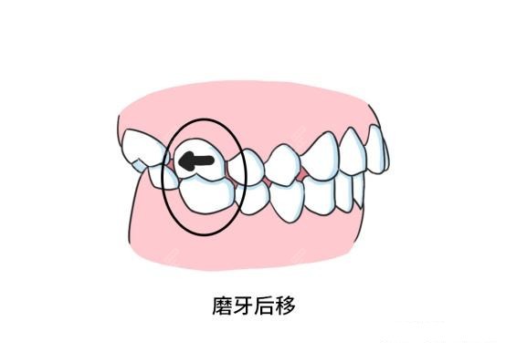 正畸选择磨牙后推可不好受