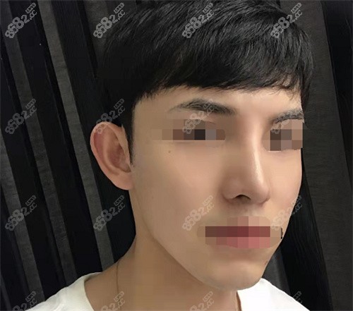 假体隆鼻术后