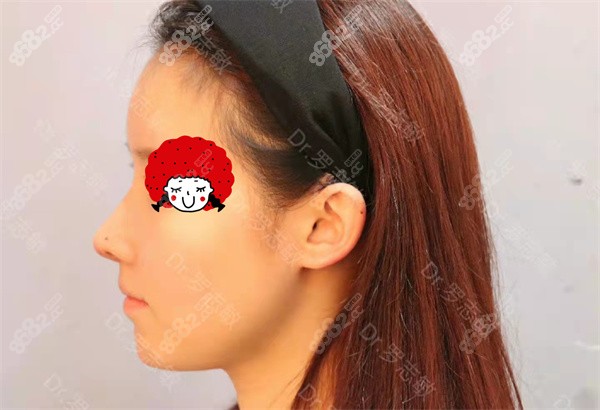 <!--<i data=20240705-sp></i>-->罗志敏做鼻子实例2