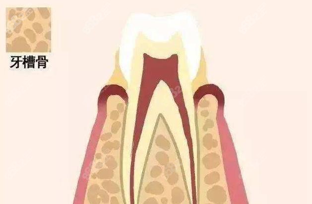 缺牙多年的人多数有牙槽骨萎缩情况
