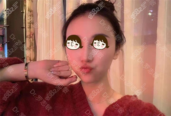 <!--<i data=20240705-sp></i>-->罗志敏做鼻子实例1