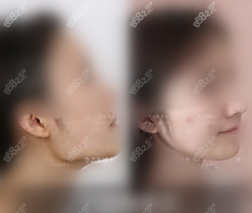 上海华美磨骨前后对比照 上海华美磨骨前后对比照