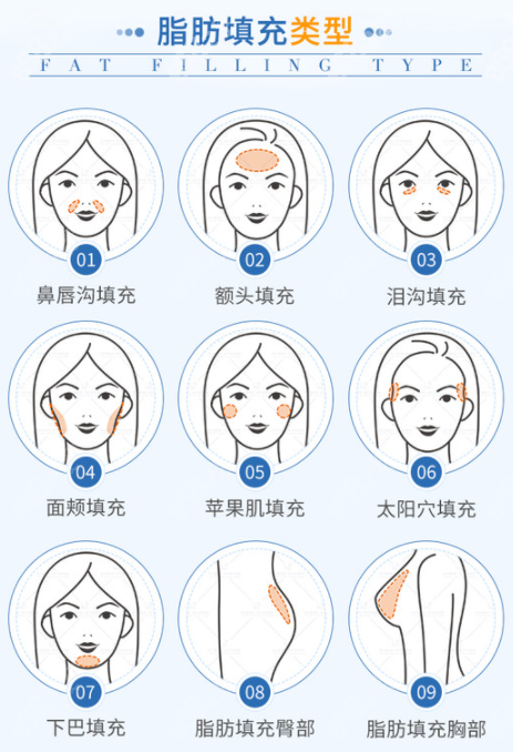 青岛诺德张冠勋院长常做的脂肪填充类型