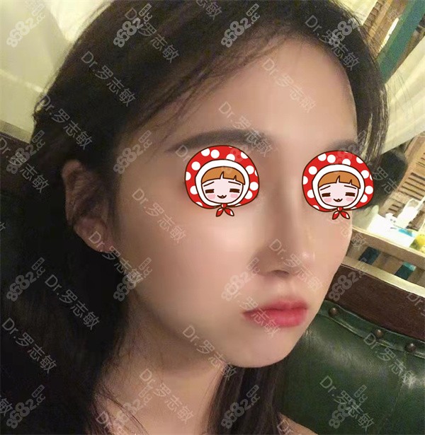 <!--<i data=20240705-sp></i>-->罗志敏做鼻子实例1
