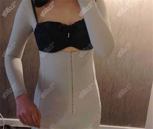 腰腹吸脂术后