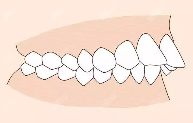 没有正畸位置强行排齐牙齿会导致龅牙哦