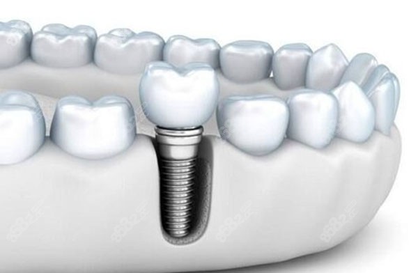 西安不同医院一颗种植牙