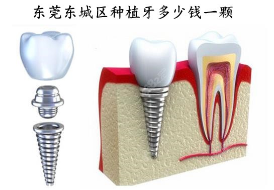 东莞东城区口腔医院种植牙价格