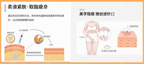 北京王明利吸脂技術優(yōu)勢