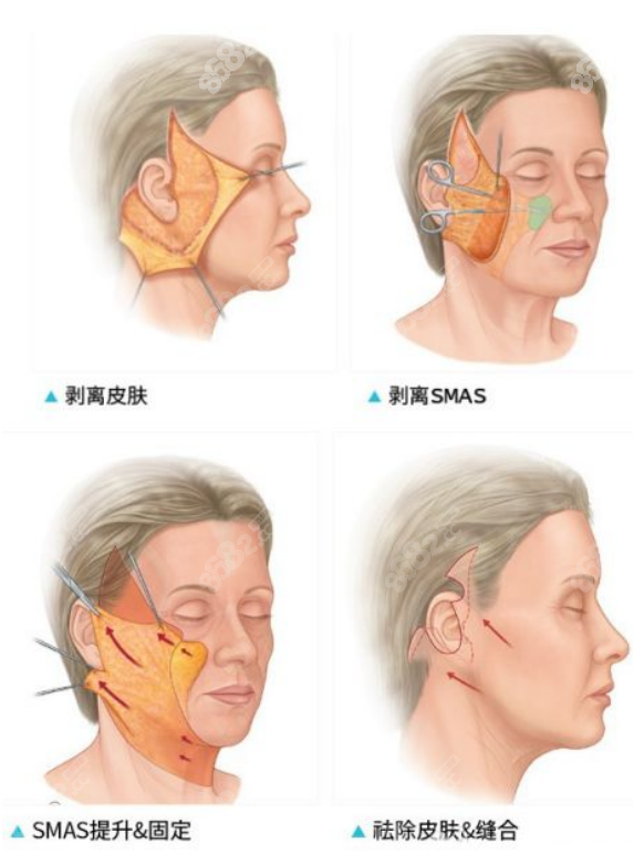 面部大拉皮手术