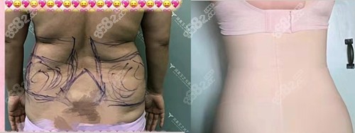 北京潤美玉之光王明利吸脂前后對比照