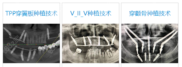 口腔种植牙技术怎么样
