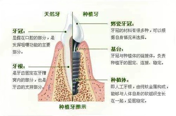 生物相容性,能够跟牙槽骨及周围组织较好的结合,从而提高了种植牙的